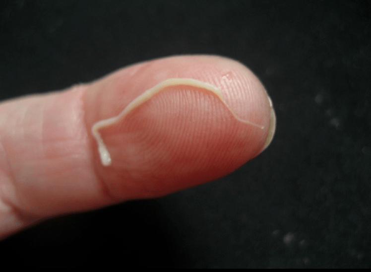 طفيليات الدودة المستديرة من جسم الإنسان